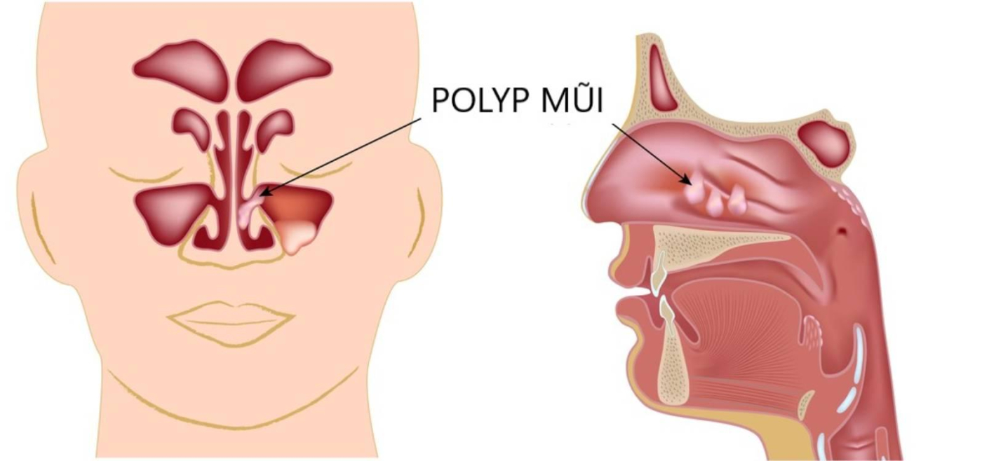 Polyp mũi có tự hết không? Nên làm gì nếu polyp mũi không tự khỏi?