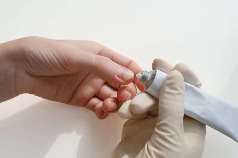 Thuốc đặc trị nấm móng tay được dùng khi nào?