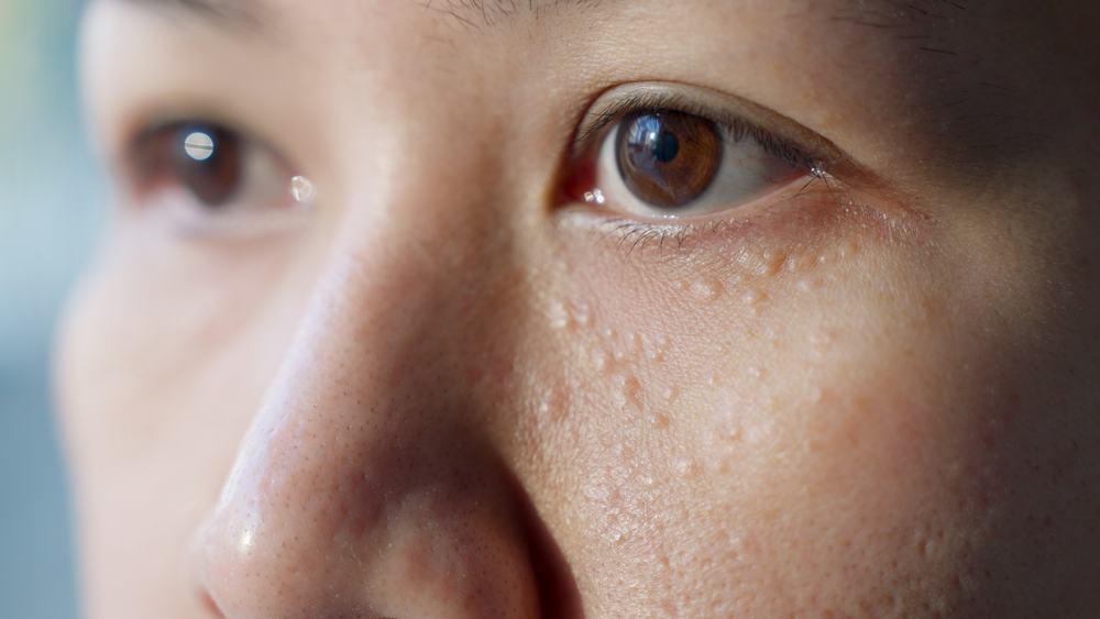 Cách trị mụn thịt trên mặt đơn giản, hiệu quả cao