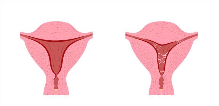 Dính buồng tử cung (hội chứng Asherman) là gì và có chữa được không?