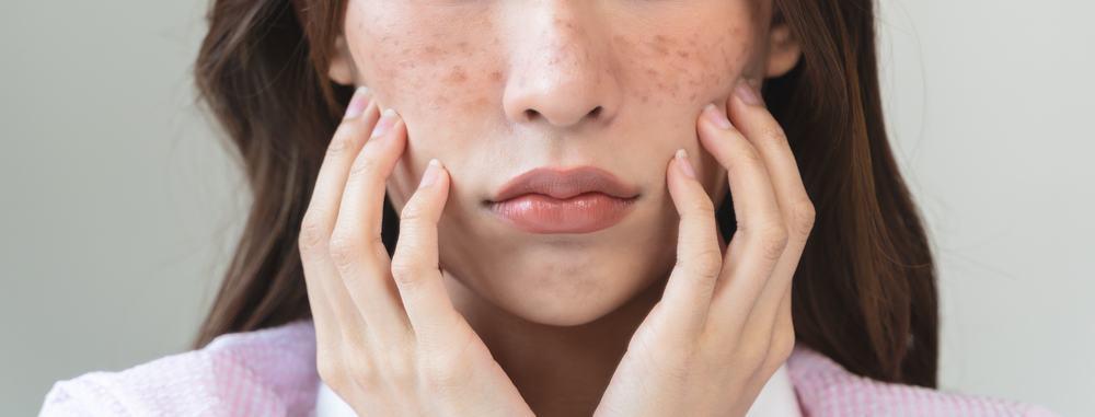 Nám chân sâu là gì? Nguyên nhân, dấu hiệu và cách điều trị hiệu quả