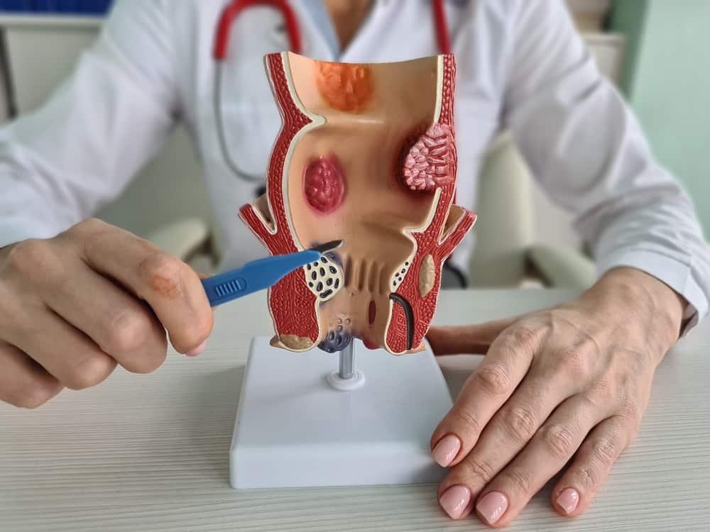 Nguyên nhân bị trĩ là gì? Liệu bạn đã biết tại sao bị trĩ chưa?