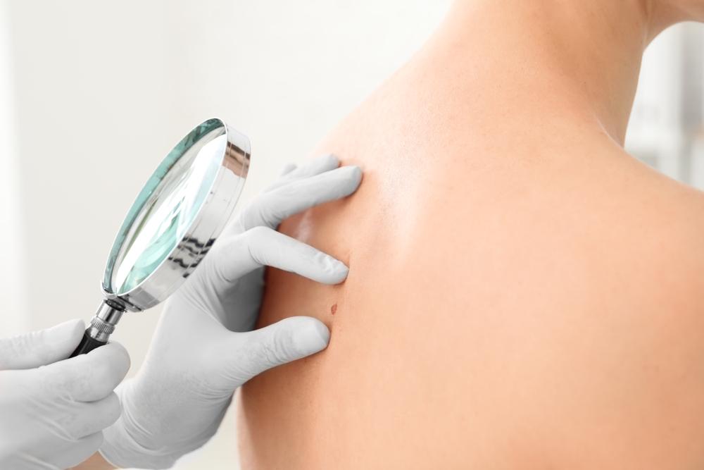 Ung thư da giai đoạn đầu là gì, điều trị như thế nào?