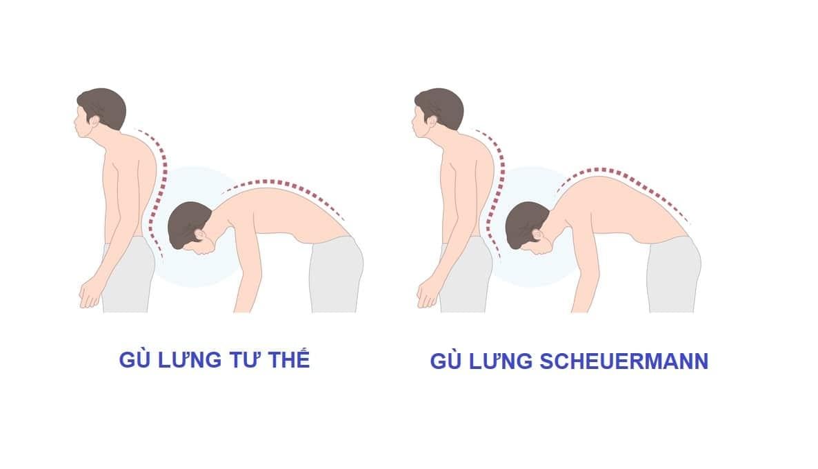 Các loại gù lưng trẻ em thường gặp