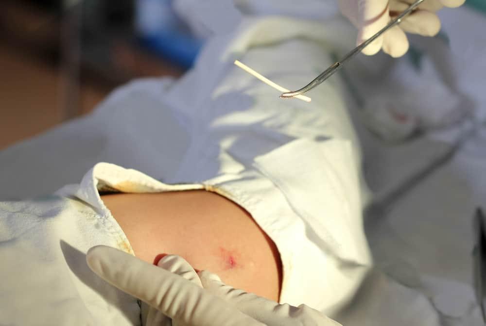 Quy trình và những điều cần biết tháo que tránh thai