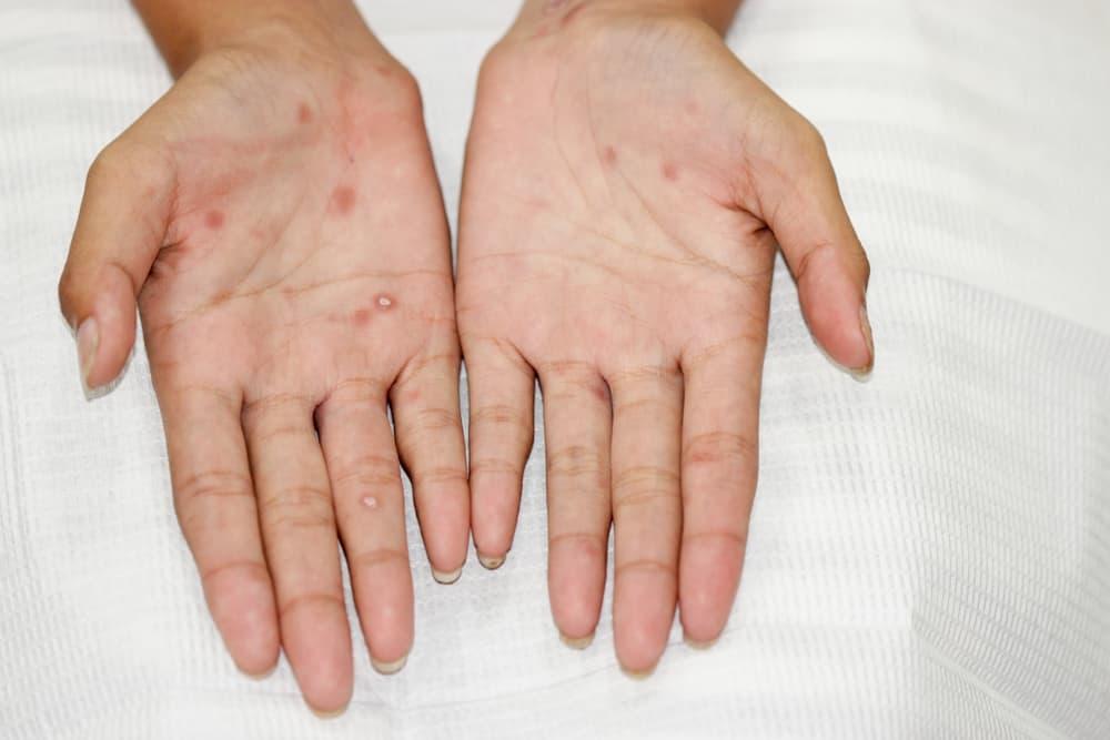 Bệnh giang mai lây qua đường nào? Có dễ lây nhiễm không?