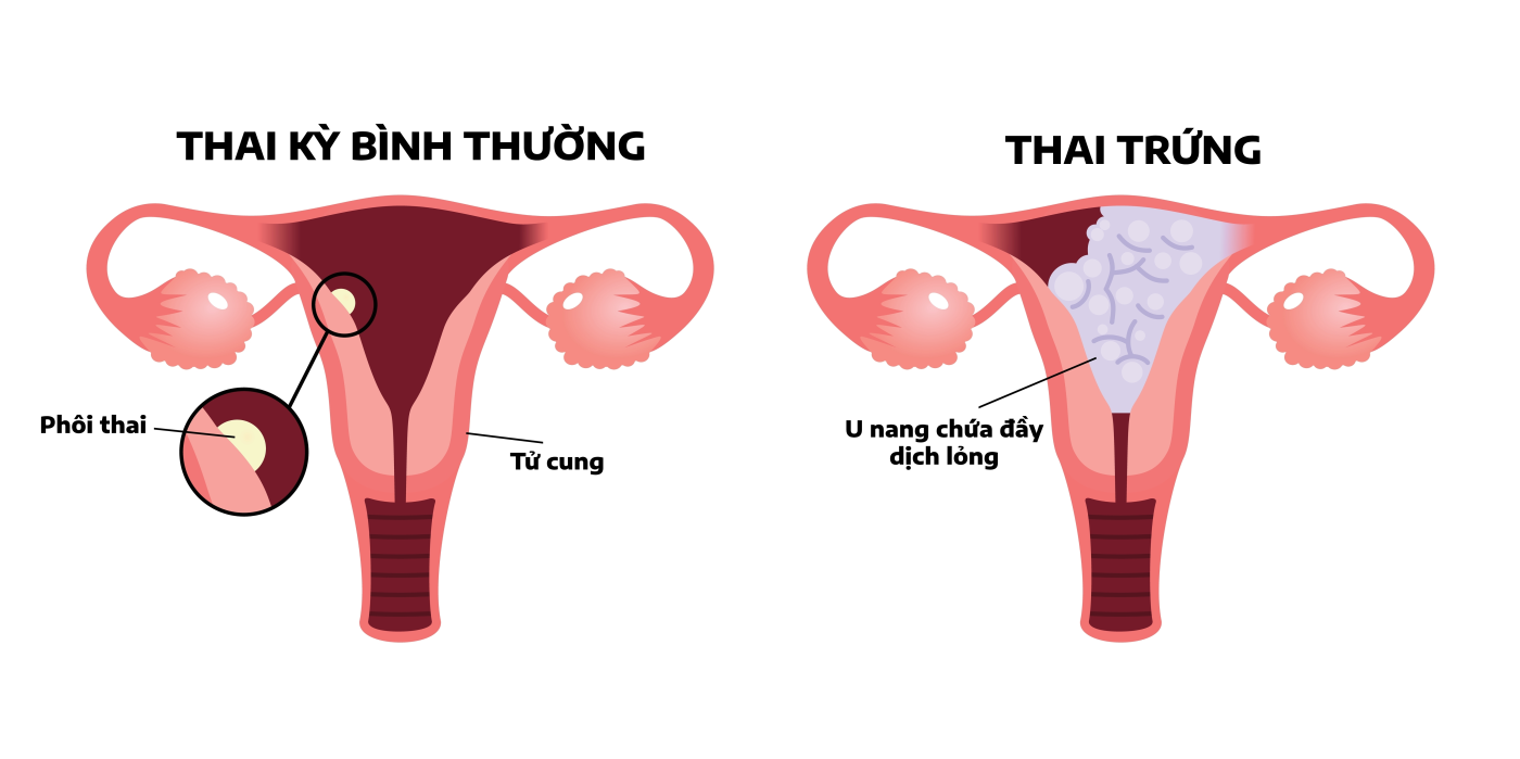 Mang thai trứng là gì? Chửa trứng có nguy hiểm không?