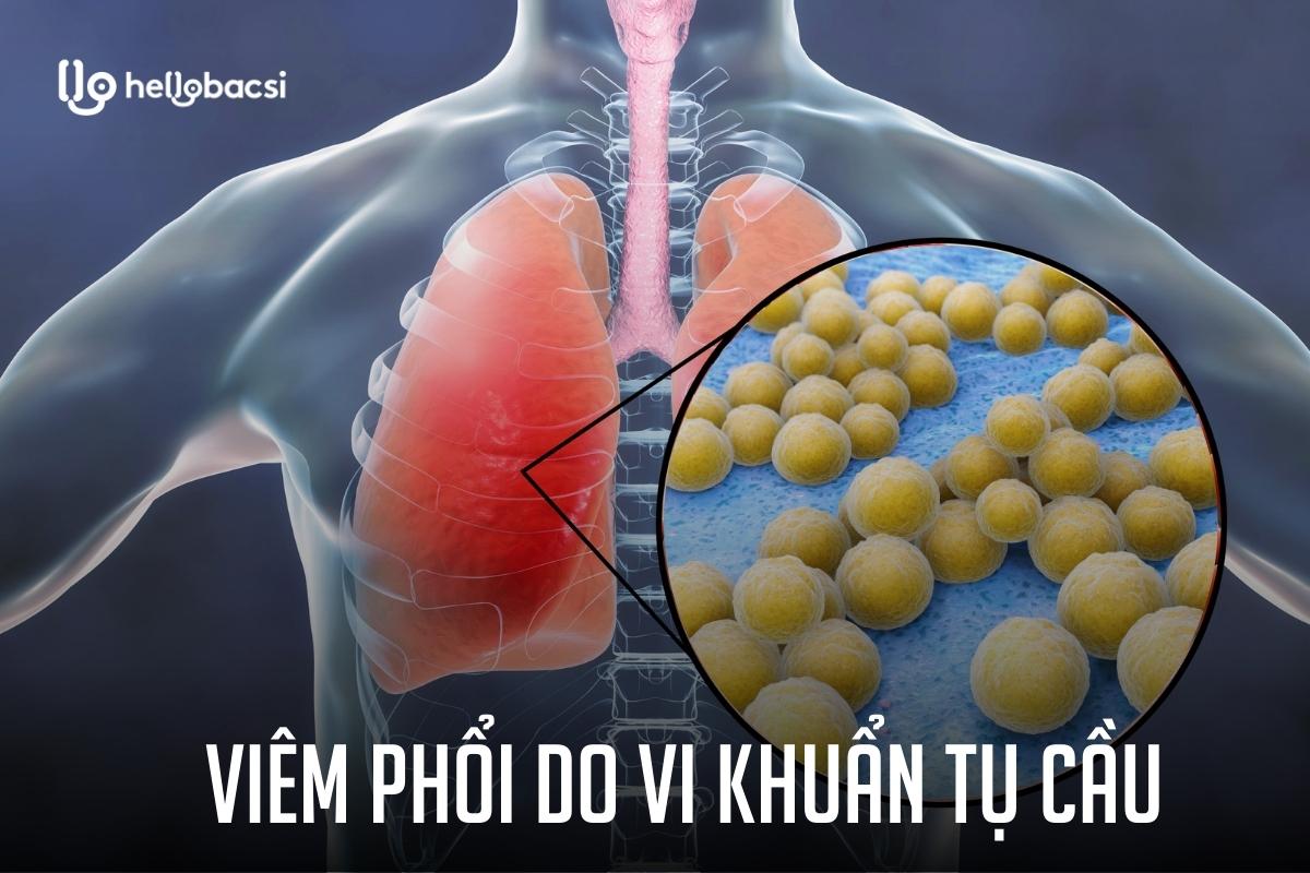 Viêm phổi do vi khuẩn tụ cầu là gì? Biểu hiện, nguyên nhân và điều trị