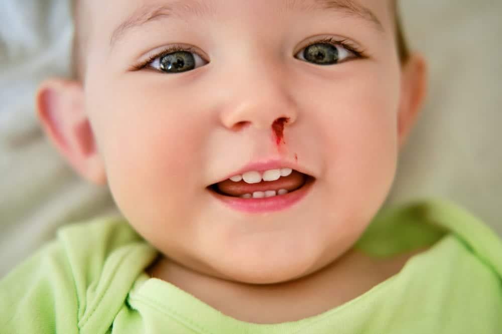 Bé hay chảy máu cam là thiếu chất gì? 5 dưỡng chất cần bổ sung ngay!