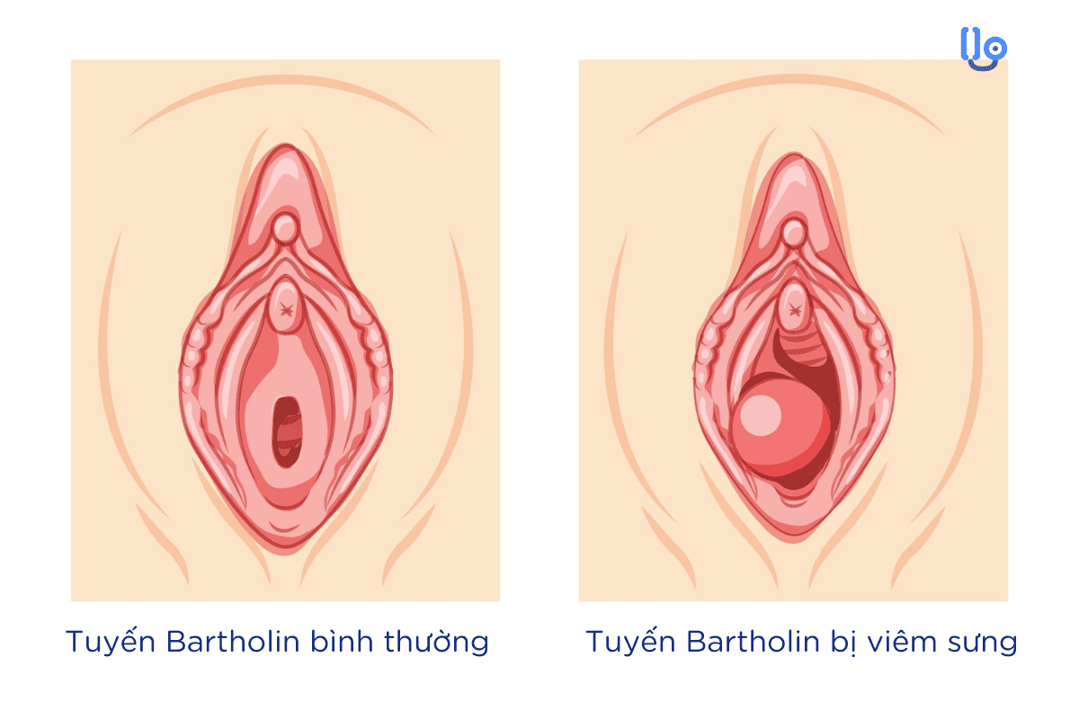 Viêm tuyến Bartholin có tự khỏi không