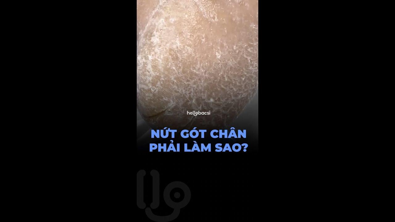 Nứt gót chân phải làm sao?