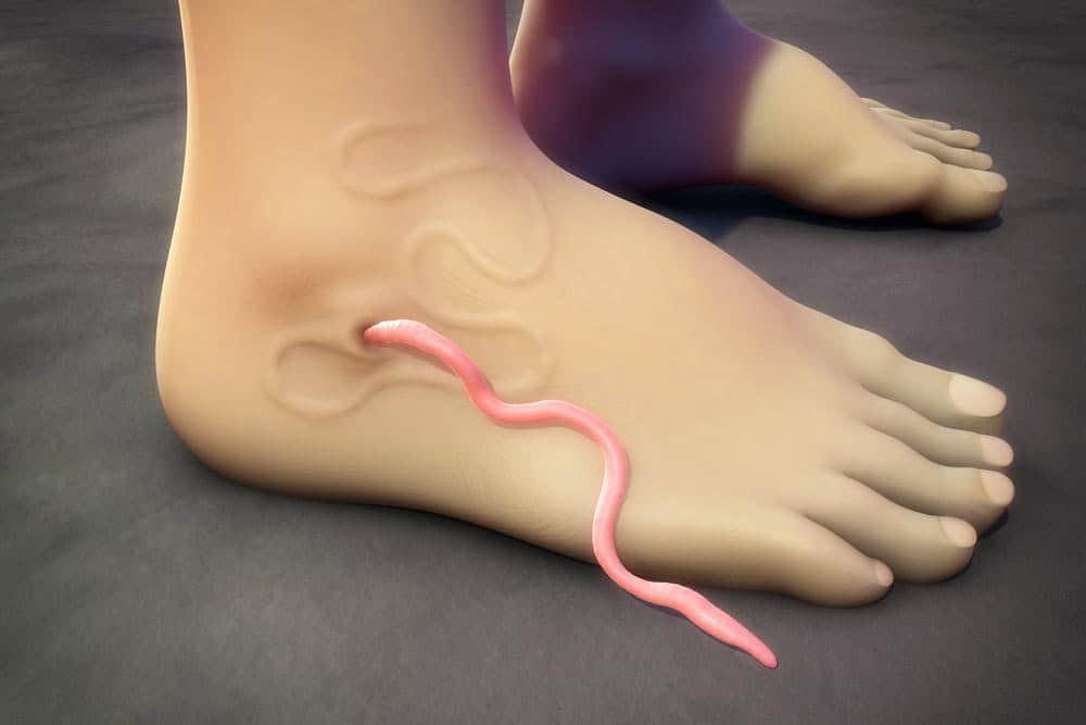 Bệnh giun rồng: Căn bệnh đã loại trừ nay xuất hiện lại ở nước ta