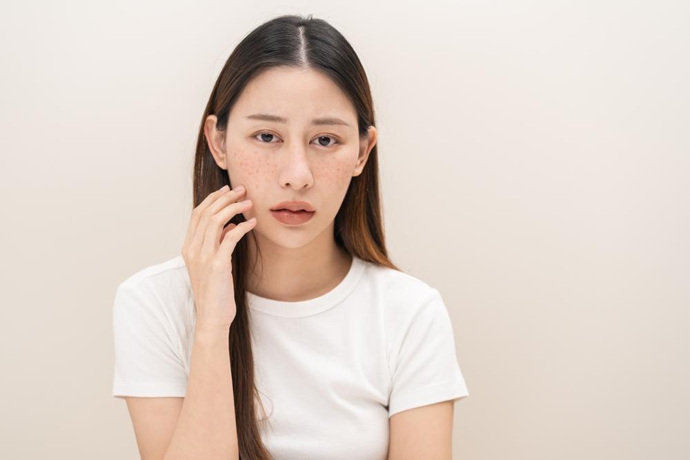 Mụn nhọt: Nguyên nhân, cách xử lý và lời khuyên từ chuyên gia