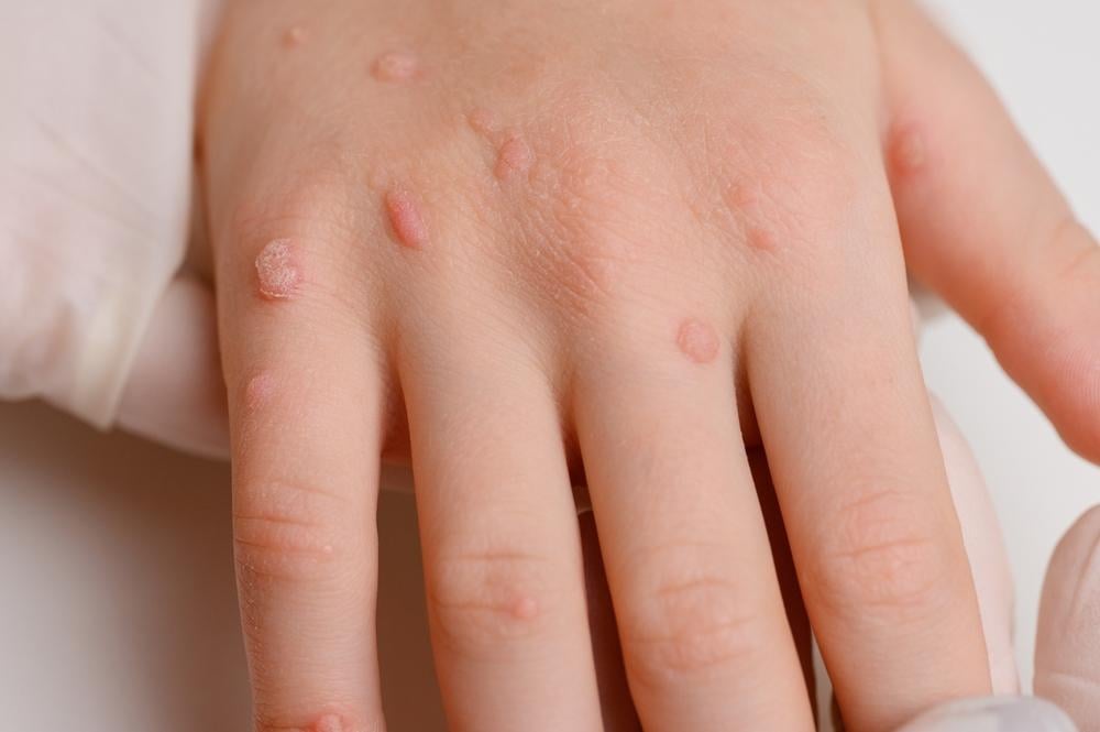 Tiêm HPV cho trẻ để bảo vệ con trước nguy cơ nhiễm mụn cóc sinh dục.