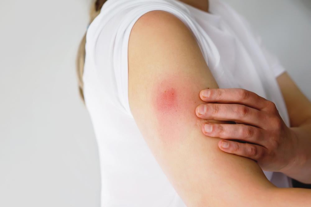 Tác dụng phụ sau tiêm vắc xin viêm màng não cho trẻ.