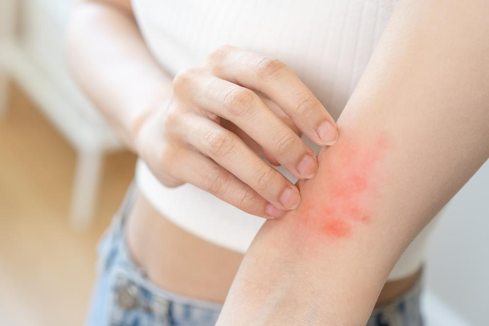 rôm sảy ở người lớn