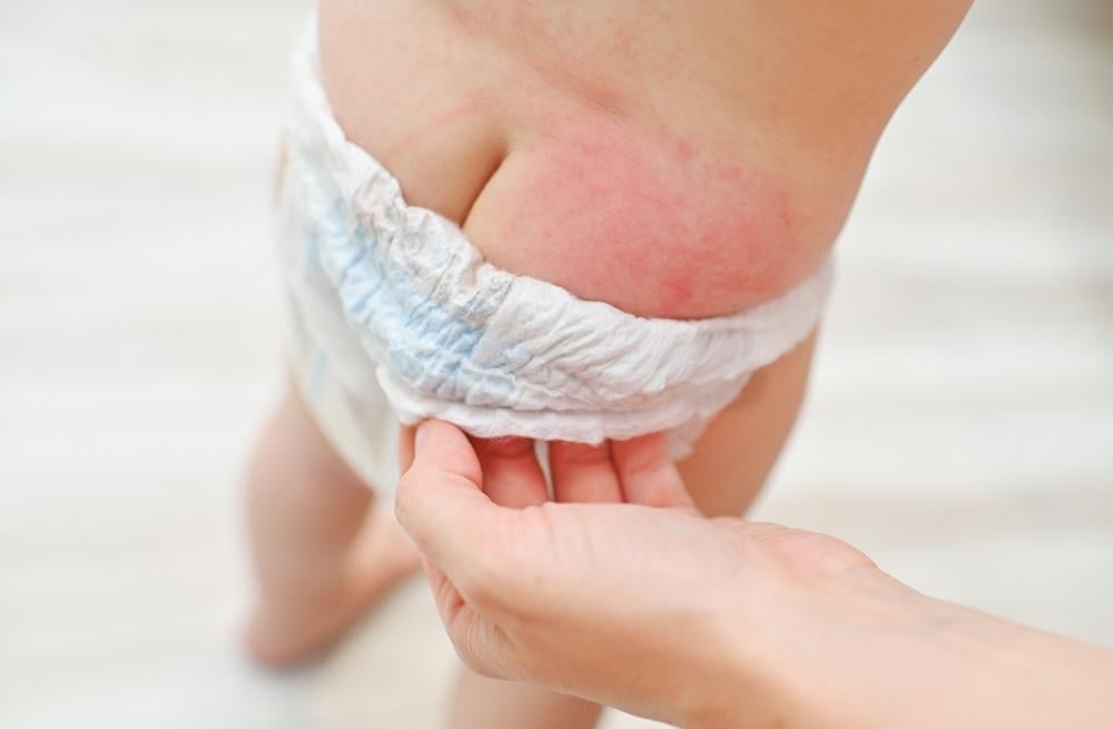 cách xử trí hăm tã