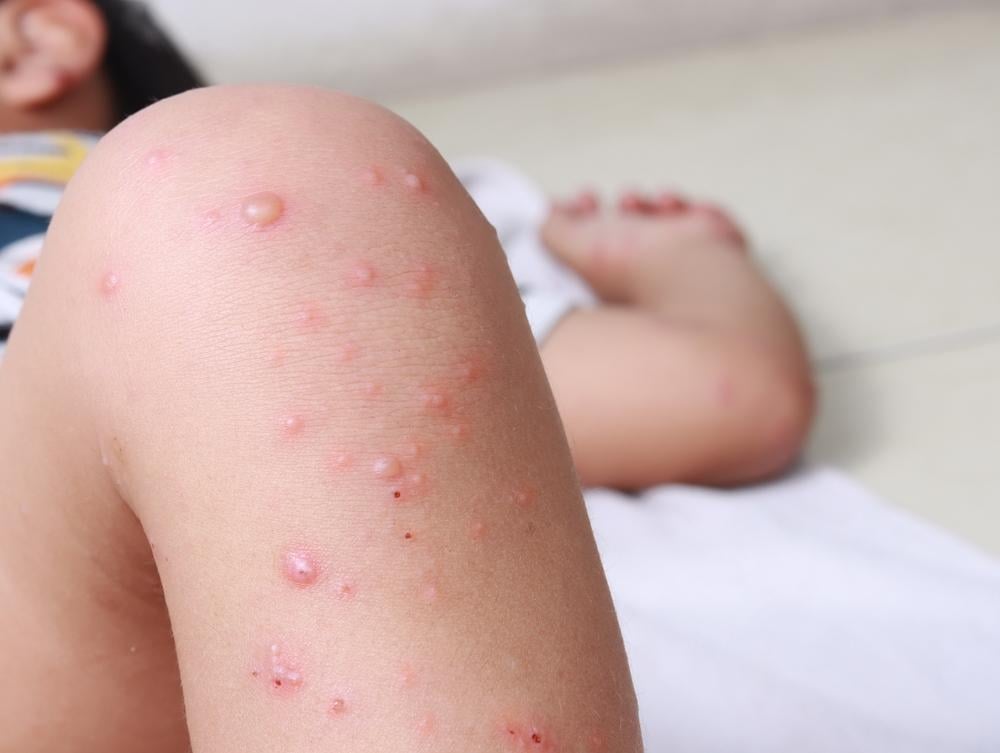 Trẻ sốt không rõ nguyên nhân