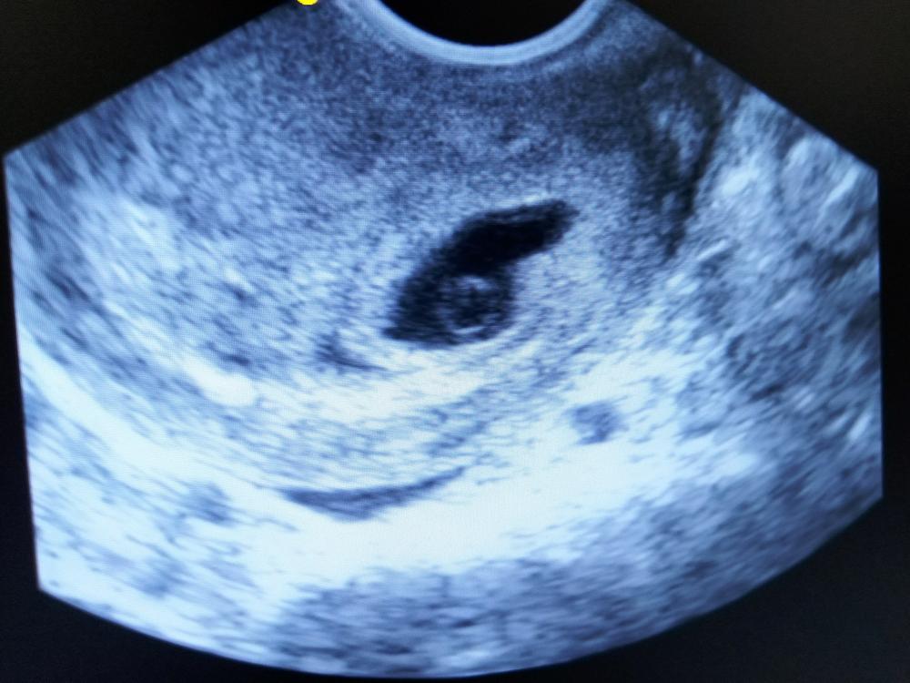 Siêu âm có yolksac là gì và những thông tin mẹ bầu cần biết