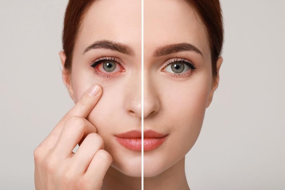 đau mắt đỏ lây qua đường nào
