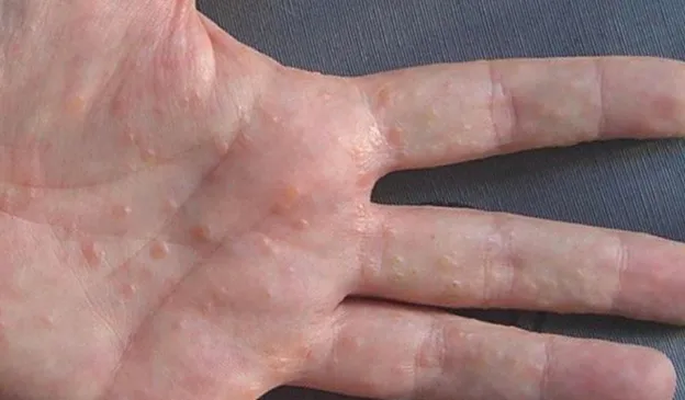 Hình ảnh bệnh tay chân miệng ở người lớn