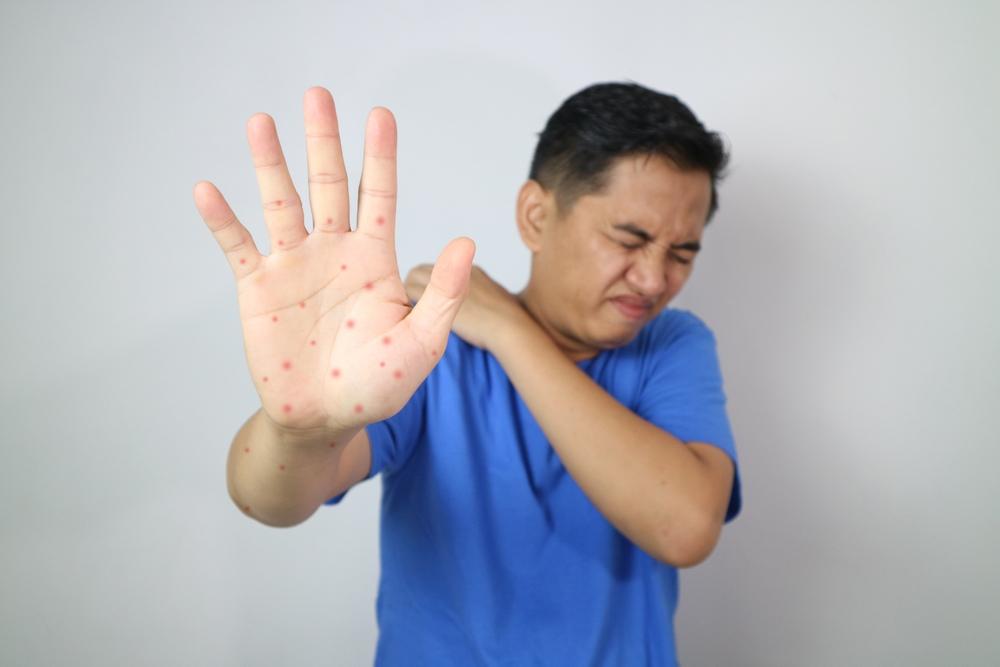 Bệnh tay chân miệng ở người lớn: Dấu hiệu, hình ảnh và cách điều trị