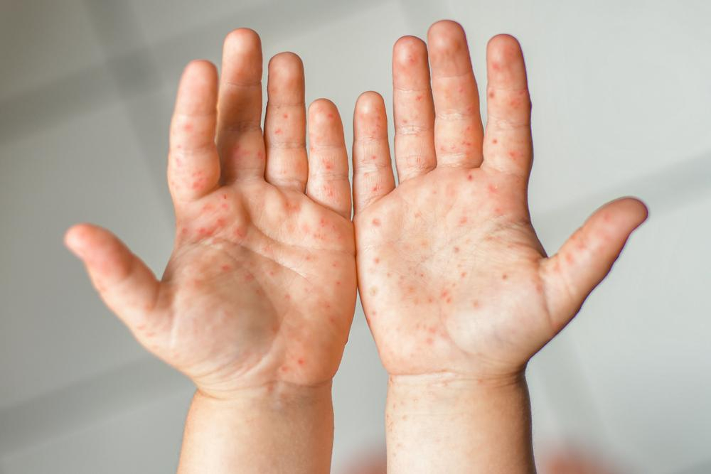 Bệnh tay chân miệng ở trẻ em: Tất cả những điều cha mẹ cần biết!