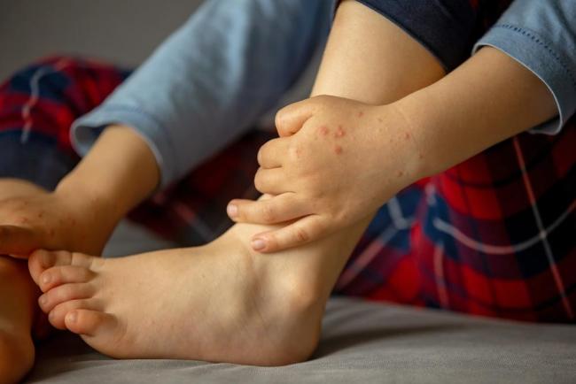 Triệu chứng tay chân miệng: Nhận biết cấp tốc để tránh biến chứng nguy hiểm