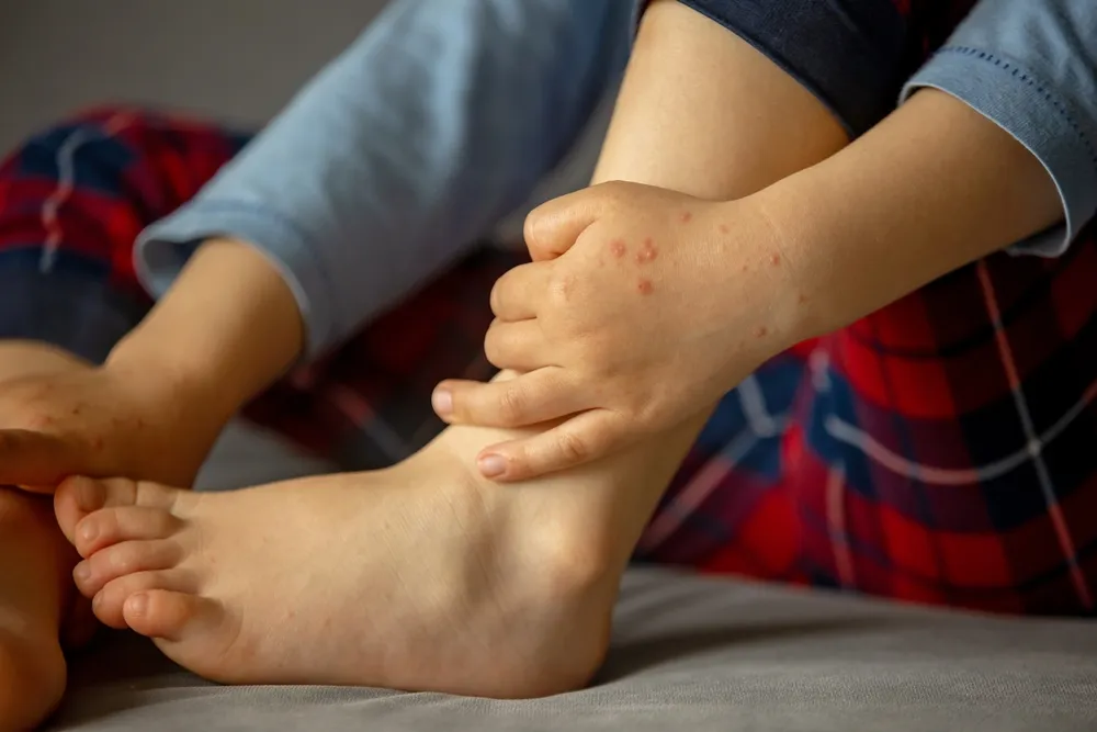 Triệu chứng tay chân miệng: Nhận biết cấp tốc để tránh biến chứng nguy hiểm