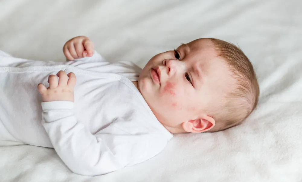 Nguyên nhân bé bị dị ứng đạm sữa bò.