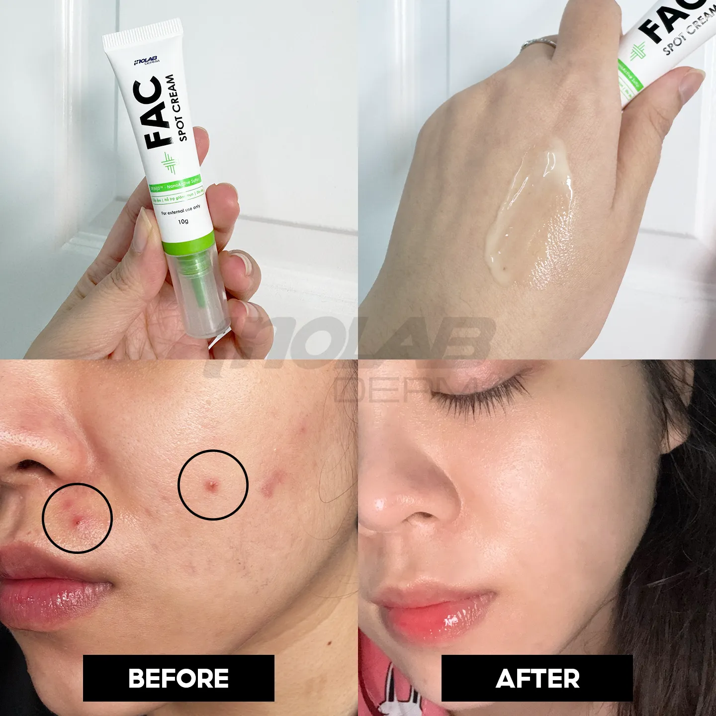 kem chấm mụn derma