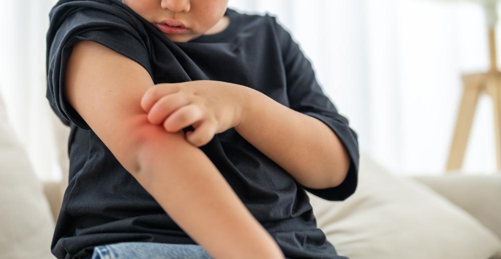 Trẻ bị nổi mẩn đỏ khi giao mùa: Bình thường hay biểu hiện cần lưu ý?